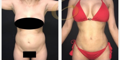 Case 7449 - Woman treated with Brazilian Butt Lift, Vaser Liposuction