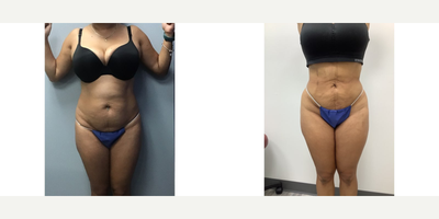 Case 7452 - 45-54 year old woman treated with Brazilian Butt Lift