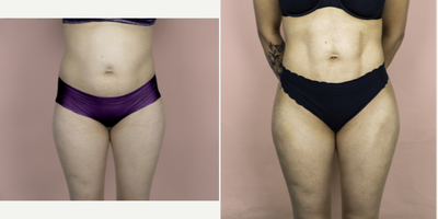 Case 7464 - 25-34 year old woman treated with Brazilian Butt Lift