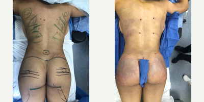 Case 7477 - 25-34 year old woman treated with Brazilian Butt Lift