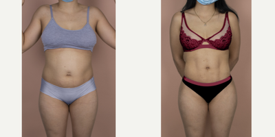 Case 7479 - 25-34 year old woman treated with Brazilian Butt Lift & Hi-Def Liposuction