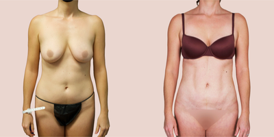 Case 7480 - 25-34 year old woman treated with Brazilian Butt Lift