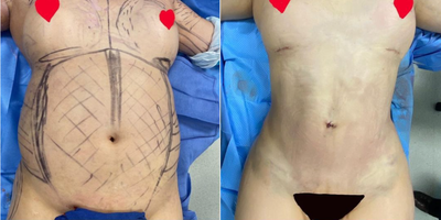 Case 7481 - Brazilian Butt Lift