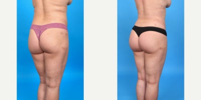 Case 7482 - 35-44 year old woman treated with Butt Augmentation, Brazilian Butt Lift