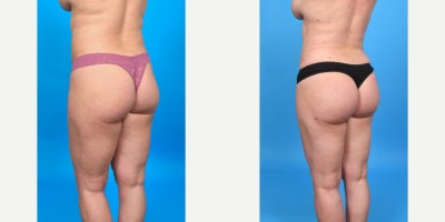 Case 7483 - 35-44 year old woman treated with Butt Augmentation, Brazilian Butt Lift