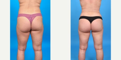 Case 7484 - 35-44 year old woman treated with Butt Augmentation, Brazilian Butt Lift