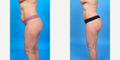 Case 7485 - 35-44 year old woman treated with Butt Augmentation, Brazilian Butt Lift