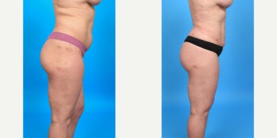 Case 7486 - 35-44 year old woman treated with Butt Augmentation, Brazilian Butt Lift
