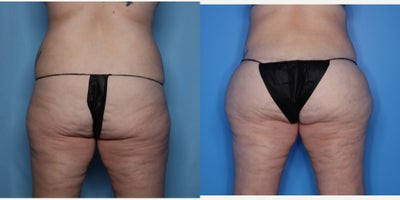 Case 7489 - 25-34 year old woman treated with Body Lift, Brazilian Butt Lift