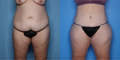 Case 7490 - 25-34 year old woman treated with Body Lift, Brazilian Butt Lift