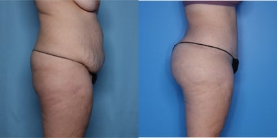 Case 7491 - 25-34 year old woman treated with Body Lift, Brazilian Butt Lift