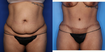 Case 75 - 25-34 year old woman treated with Tummy Tuck
