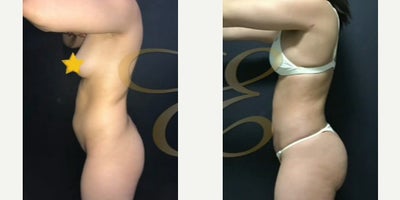 Case 7500 - Woman treated with Vaser Liposuction, Brazilian Butt Lift