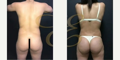 Case 7501 - Woman treated with Vaser Liposuction, Brazilian Butt Lift