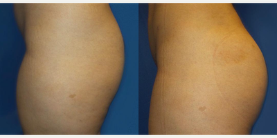 Case 7512 - Woman treated with Brazilian Butt Lift, Liposuction, Butt Lift, Butt Augmentation