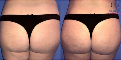 Case 7517 - Woman treated with Liposuction, Butt Lift, Butt Augmentation, Brazilian Butt Lift