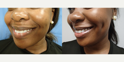 Case: 7523 - before and after photo of 35-44 year old woman treated with Dimple Surgery by Peter Chang, MD