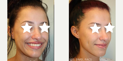 Case: 7525 - before and after photo of 25-34 year old woman treated with Dimple Surgery by C. Carson Huynh, MD, DMD, FACS