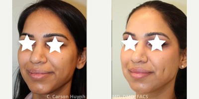 Case: 7526 - before and after photo of 25-34 year old woman treated with Dimple Surgery by C. Carson Huynh, MD, DMD, FACS