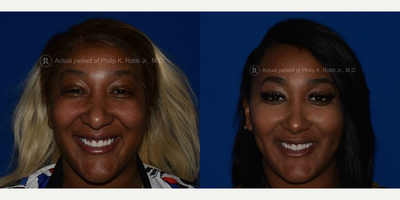 Case: 7527 - before and after photo of Dimpleplasty by Philip K. Robb Jr., MD, FACS