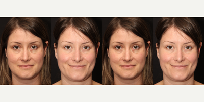 Case: 7528 - before and after photo of 25-34 year old woman treated with Dimpleplasty by Philip Solomon, MD, FRCS