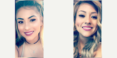 Case: 7529 - before and after photo of 18-24 year old woman treated with Dimpleplasty by Peter Chang, MD