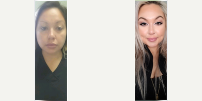 Case: 7530 - before and after photo of 25-34 year old woman treated with Timeless Dimpleplasty by Peter Chang, MD