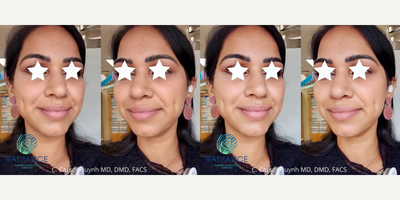 Case: 7531 - before and after photo of 25-34 year old woman treated with Dimple Surgery by C. Carson Huynh, MD, DMD, FACS