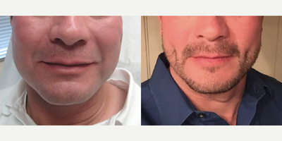 Case 7533 - 35-44 year old man treated with Dimpleplasty