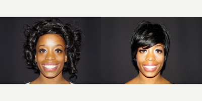 Case 7535 - 25-34 year old woman treated with Dimpleplasty