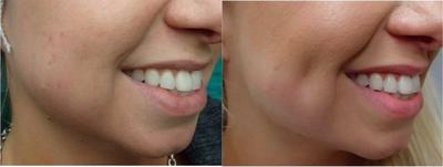 Case 7536 - 25-34 year old woman treated with Cheek Augmentation