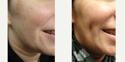 Case 7538 - 35-44 year old woman treated with Dimple Surgery