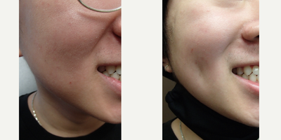 Case 7539 - 18-24 year old man treated with Dimple Surgery