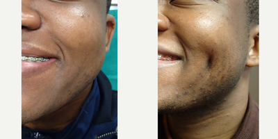 Case 7540 - 18-24 year old man treated with Dimple Surgery