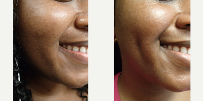 Case 7541 - 35-44 year old woman treated with Dimple Surgery