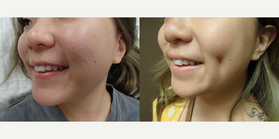 Case 7542 - 25-34 year old woman treated with Dimple Surgery