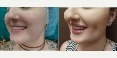 Case 7549 - 25-34 year old woman treated with Dimpleplasty