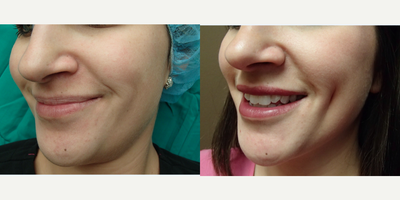 Case 7550 - 25-34 year old woman treated with Dimpleplasty