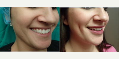 Case 7551 - 25-34 year old woman treated with Dimpleplasty