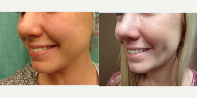 Case 7552 - 18-24 year old woman treated with Dimpleplasty