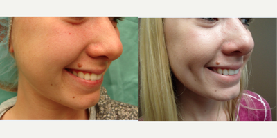 Case 7553 - 18-24 year old woman treated with Dimpleplasty