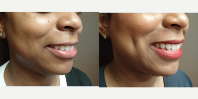 Case 7554 - 25-34 year old woman treated with Dimpleplasty