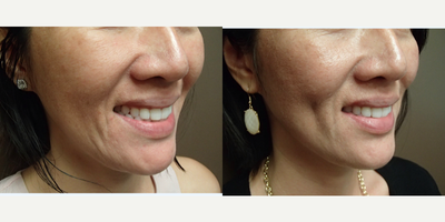 Case 7555 - 25-34 year old woman treated with Dimpleplasty