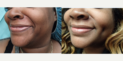 Case 7556 - 35-44 year old woman treated with Dimpleplasty