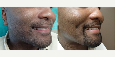 Case 7557 - 35-44 year old man treated with Dimpleplasty