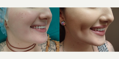 Case 7558 - 25-34 year old woman treated with Dimpleplasty