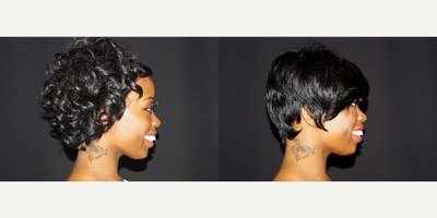 Case 7559 - 25-34 year old woman treated with Dimpleplasty