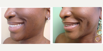 Case 7560 - 18-24 year old woman treated with Cheek Augmentation