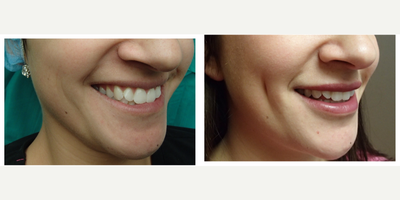 Case 7561 - 25-34 year old woman treated with Cheek Augmentation