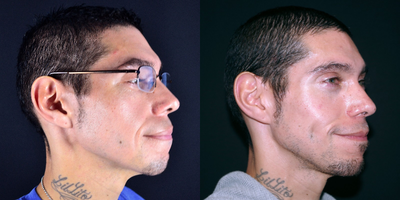 Case 7562 - 35-44 year old man received treatment for Dimple Creation